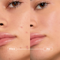 3701129805367_Sebium_Kerato+_30ml5_vysledky1_pred_po