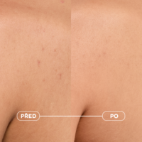 3701129812433_Sebium_Kerato+_Body4_vysledky1_pred_po